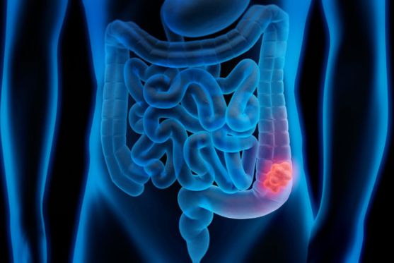 Dr. Vijay Bansal - Colorectal Cancer Surgeon in Mohali